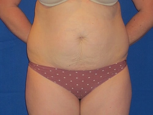 Tummy Tuck Before & After