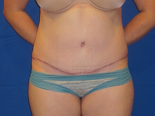 Tummy Tuck Before & After