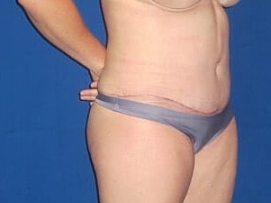 Tummy Tuck Before & After