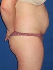 Tummy Tuck Before & After