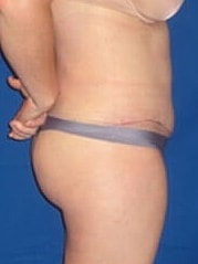 Tummy Tuck Before & After