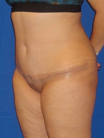 Tummy Tuck Before & After