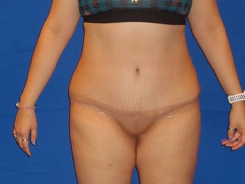 Tummy Tuck Before & After