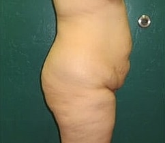 Tummy Tuck Before & After