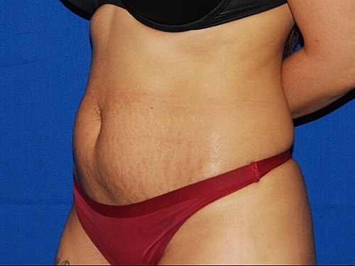 Tummy Tuck Before & After
