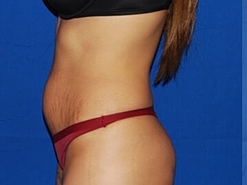 Tummy Tuck Before & After