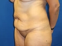 Tummy Tuck Before & After