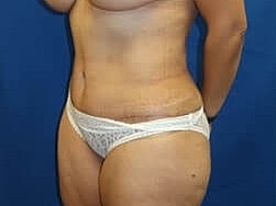 Tummy Tuck Before & After