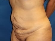Tummy Tuck Before & After
