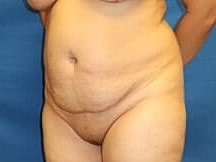 Tummy Tuck Before & After