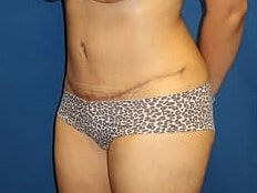 Tummy Tuck Before & After