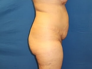 Tummy Tuck Before & After