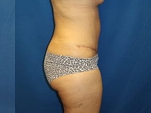 Tummy Tuck Before & After