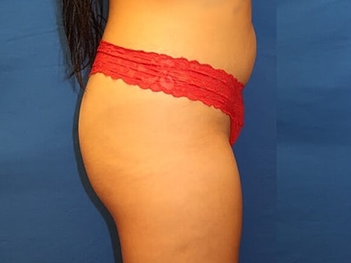 Brazilian Butt Lift Before & After