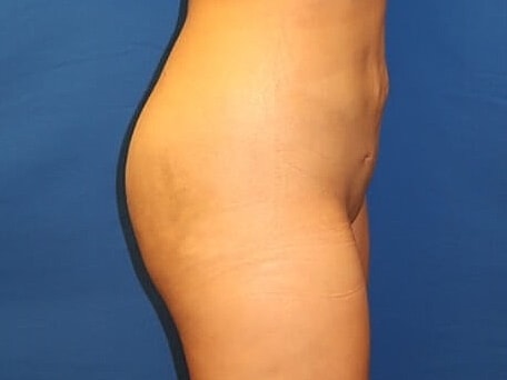 Brazilian Butt Lift Before & After