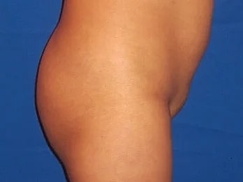 Brazilian Butt Lift Before & After