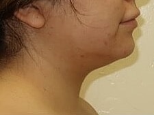 Liposuction Before & After