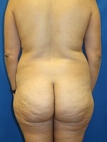 Liposuction Before & After