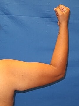 Liposuction Before & After