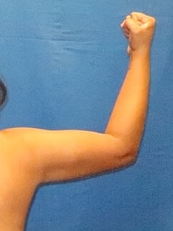 Liposuction Before & After