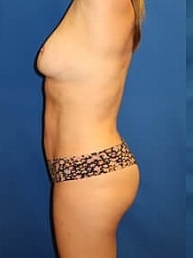 Liposuction Before & After