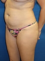 Liposuction Before & After