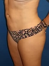 Liposuction Before & After