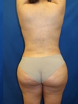 Liposuction Before & After