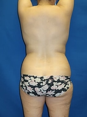 Liposuction Before & After