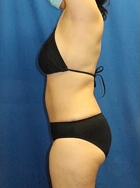 Liposuction Before & After