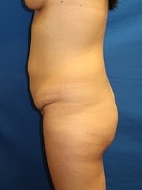 Liposuction Before & After