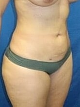 Liposuction Before & After