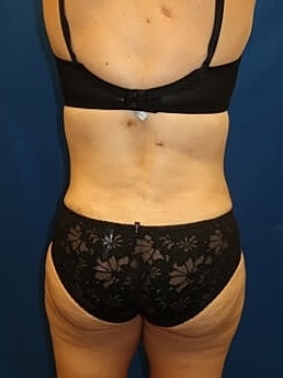 Liposuction Before & After