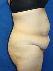 Liposuction Before & After