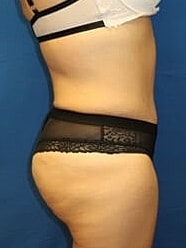 Liposuction Before & After