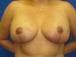 Breast Augmentation With Lift Before & After