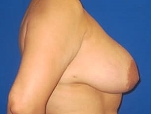 Breast Augmentation With Lift Before & After