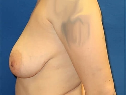 Breast Augmentation With Lift Before & After