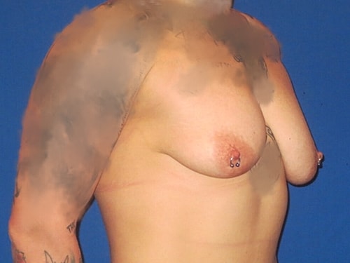 Breast Augmentation With Lift Before & After