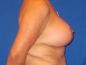 Breast Augmentation With Lift Before & After