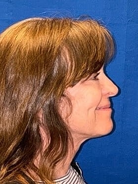 Facelift Before & After