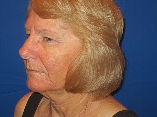 Facelift Before & After