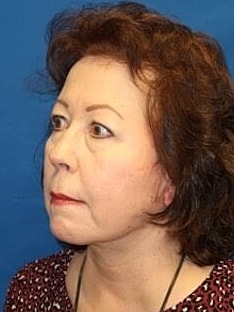 Facelift Before & After