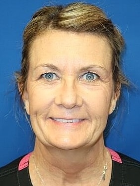 Facelift Before & After