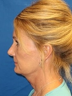 Facelift Before & After