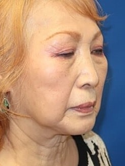 Facelift Before & After