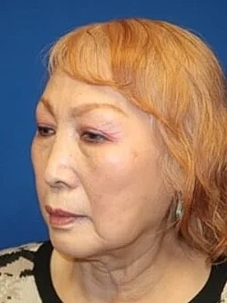 Facelift Before & After