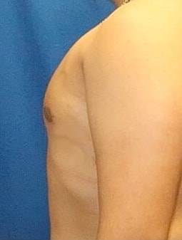 Gynecomastia Treatment Before & After