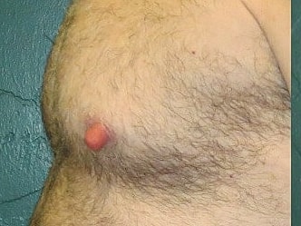 Gynecomastia Treatment Before & After