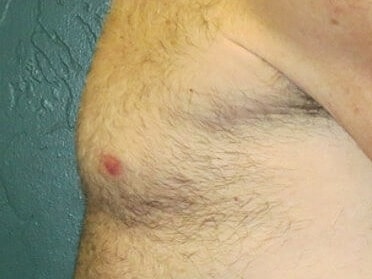 Gynecomastia Treatment Before & After